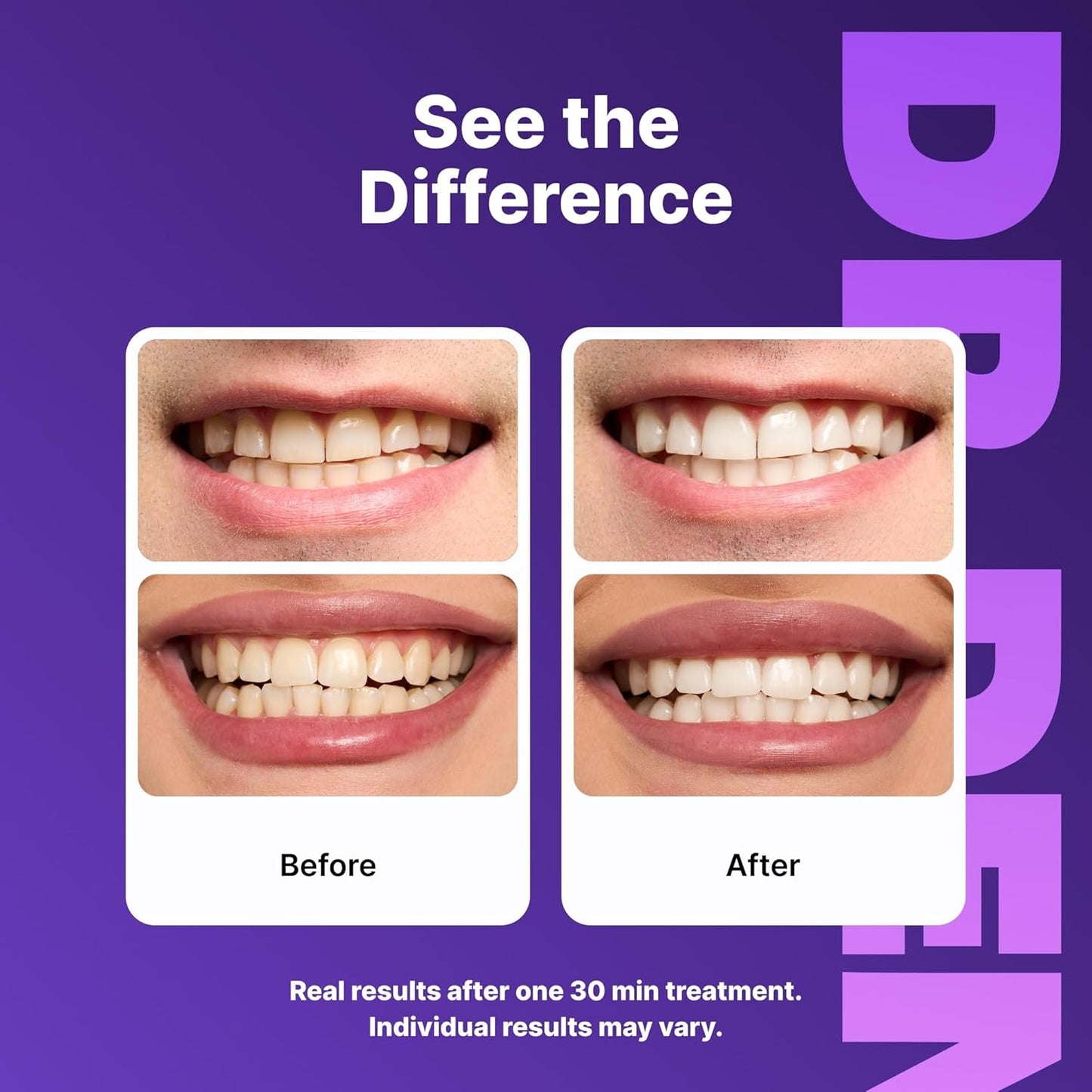 DRDENT Purple شرائط تبييض الأسنان من
